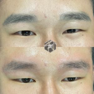 Xóa Lông Mày Bằng Laser